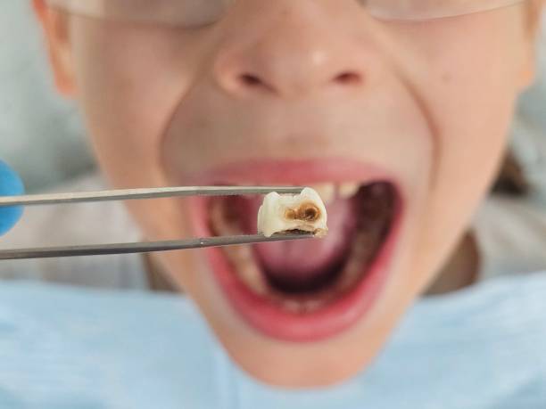 Best Knocked-Out Tooth Emergency  in Beloit, WI